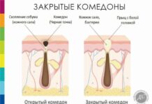 Закрытые комедоны: реально ли избавиться?