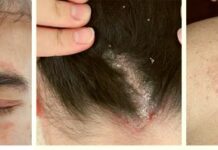 Себорея (себорейный дерматит): причины, симптомы и лечение в статье дерматолога Кулик А. В.