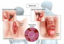 Шанкр мягкий: причины, симптомы и лечение в статье венеролога Агапов С. А.