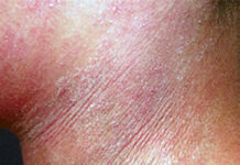 Экзема на шее – причины появления и лечение 2021