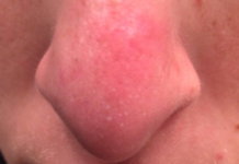 Как избавиться от шишки на носу? | Анатомия