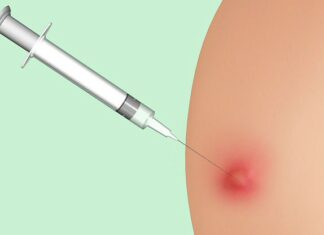 Как быстро избавиться от шишек от уколов | MedInHome