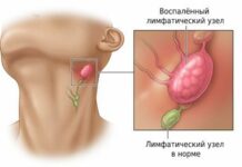 Шейный лимфаденит: причины, симптомы и лечение в статье стоматолога-хирурга Козлов П. Ю.