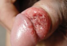 Язвы при сифилисе: как выглядят и как лечить.