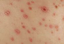 Сифилитическая сыпь: вид, диагностика, лечение