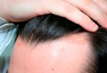 Опоясывающий лишай красить волосы