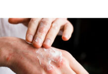 Симптомы экземы на руках и как ее лечить