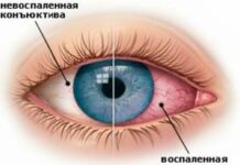 Как лечить легкие травмы глаз — Новости и публикации.