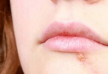 Герпес против коронавируса: есть ли связь, может ли быть симптомом заражения, методы лечения