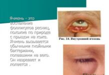 Ячмень на глазу — от чего, как появляется и откуда берется, как проходит
