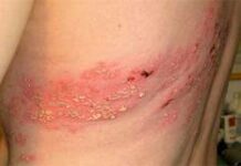 Опоясывающий лишай (герпес зостер). Причины, симптомы и признаки, диагностика и лечение болезни.