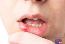 5 безопасных средств, которые помогут при стоматите