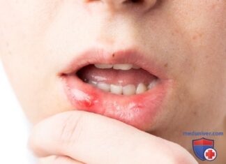 5 безопасных средств, которые помогут при стоматите