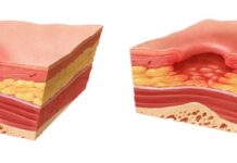 Трофические язвы нижних конечностей: лечение, стадии и причины возникновения