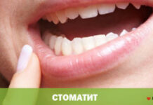 Стоматит: виды, лечение, советы специалистов