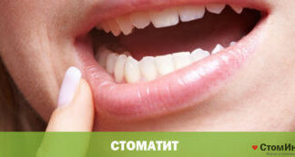 Стоматит: виды, лечение, советы специалистов
