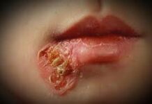 Стрептодермия: причины, симптомы, как заражаются, куда обратиться, кто лечит, стрептодермия у детей, взрослых, беременных