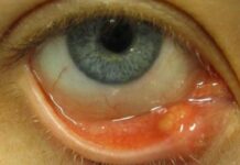 Как убрать ячмень быстро в домашних условиях. Экспресс-помощь при появлении ячменя на глазу. Лечение ячменя с помощью трав