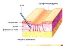 Новейшая методика, как убрать рубцы от прыщей на лице без следа и выровнять кожу