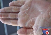 Как бороться с сухостью рук? Как лечить шелушение кожи рук?