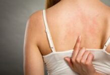 Как лечить сыпь на коже после Ковид-19 | Солнышко