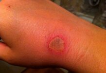 Трофические язвы на руках: диагностика и лечение