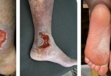 Трофическая язва: причины, симптомы и лечение в статье флеболога Густелёв Ю. А.