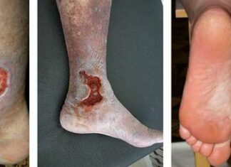 Трофическая язва: причины, симптомы и лечение в статье флеболога Густелёв Ю. А.