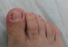 Лечение вросшего ногтя на большом пальце ноги, операция по удалению вросшего ногтя на ногах