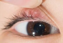 Как убрать ячмень на глазу