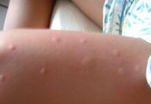 Аллергия на комариный укус у ребенка — что делать? Как лечить кулицидоз?