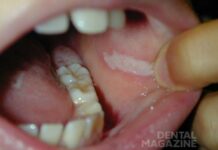 Прикусил щеку изнутри образовалась язвочка чем лечить