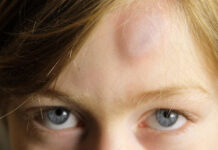 Под кожей образовалась шишка после ушиба | Что делать