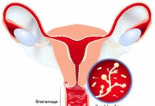 Вагинальный кандидоз: причины, симптомы и лечение в статье гинеколога Соснина А. С.