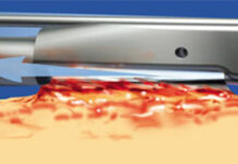 Очищение трофических язв — Инновационный сосудистый центр — ИСЦ