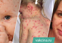 Ветряная оспа (ветрянка) у детей и взрослых: симптомы, осложнения, как не заразиться