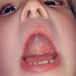 Ветрянка во рту у ребенка: фото, чем обработать, лечить, полоскать