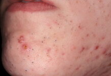 Виды комедонов — ПРОПЕЛЛЕР