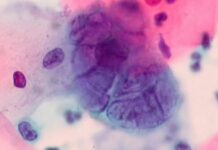 Вирус герпеса и рак: есть ли связь, преимущества лечения