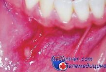 Высокая температура при стоматите у детей. Признаки вирусного стоматита и его лечение