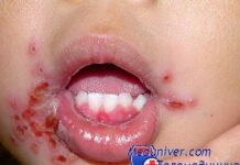 Стоматит и эпиглотит у гематологических пациентов с лейкозом — диагностика, лечение