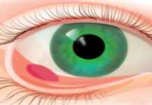 Внутренний ячмень на глазу: причины, симптомы, лечение, профилактика