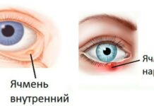 Ячмень по психосоматике Луизы Хей и Лиз Бурбо