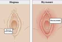 Вульвит: причины, симптомы и лечение в статье гинеколога Симанина С. В.