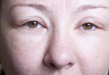 Отеки кожи лица: причины, как проявляется отечность, как избавиться от припухлостей