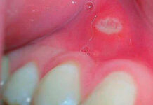 Язва на десне — что делать, причины, лечение? | Місто Дент