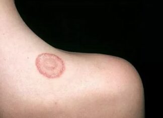 Как лечить монетовидную экзему