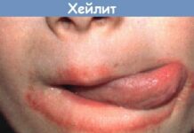 Воспаление губ у ребенка — хейлит