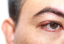 Вскрытие ячменя: цены на операцию в Москве | Хирургическое вскрытие ячменя в клинике