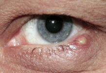 Ячмень или конъюнктивит: в чем разница, основные отличия